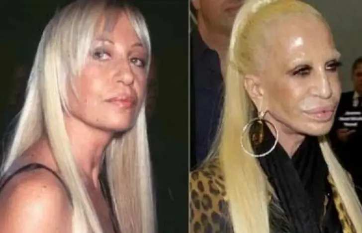 All to know about Donatella Versace plastic surgery.