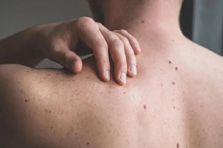 Beauty marks vs moles: What’s the difference?