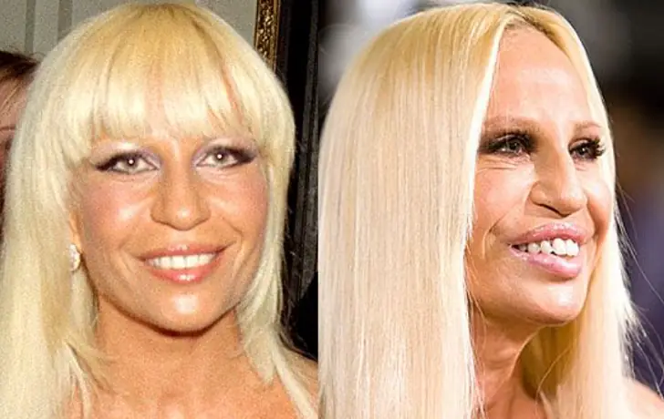 All to know about Donatella Versace plastic surgery.